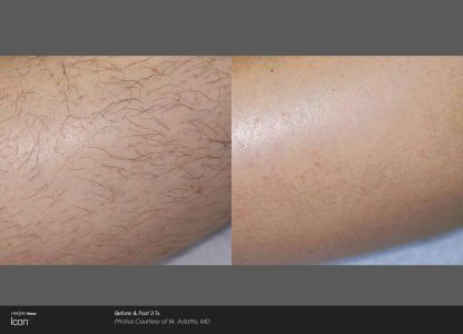 Hair Removal Before & After