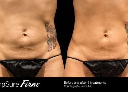 Before & After Five Treatments