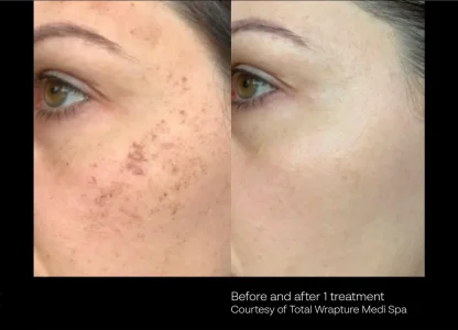 Before & After One Treatment