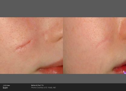 Scar Removal Before & After
