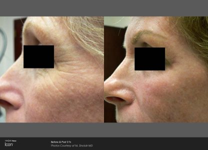 Skin Renewal Before & After