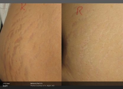 Stretch Mark Before & After
